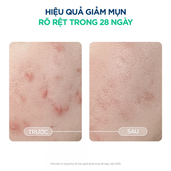 Kem dưỡng giảm mụn cho da mụn viêm nhạy cảm Bioderma Sébium Sensitive - 30 ml