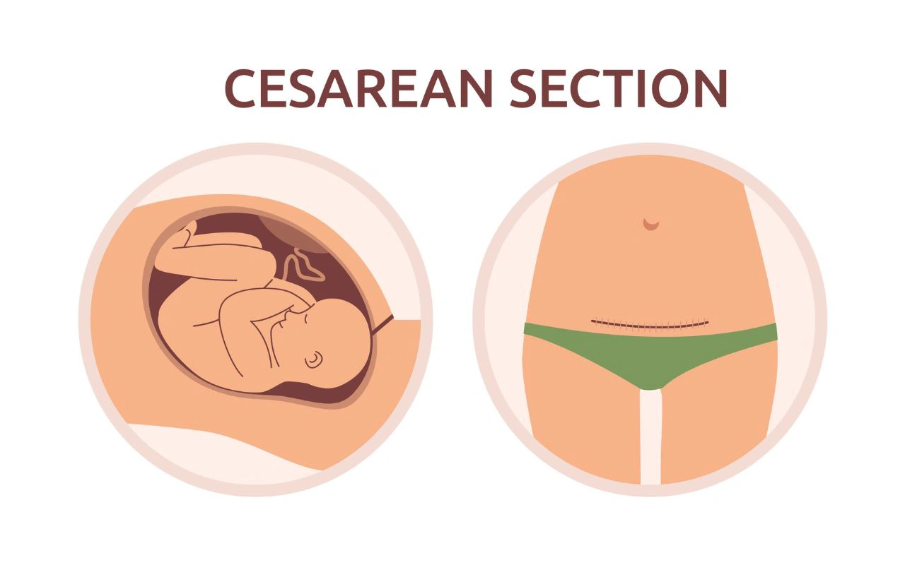 Phương pháp sinh mổ