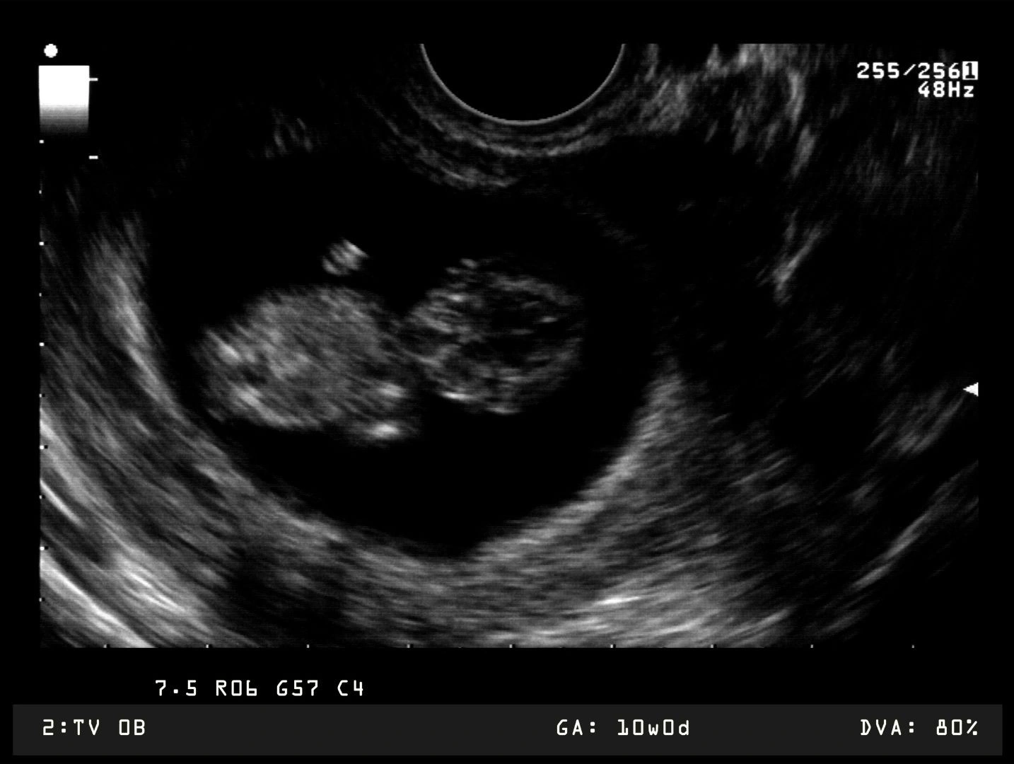 kích thước thai tuần 12