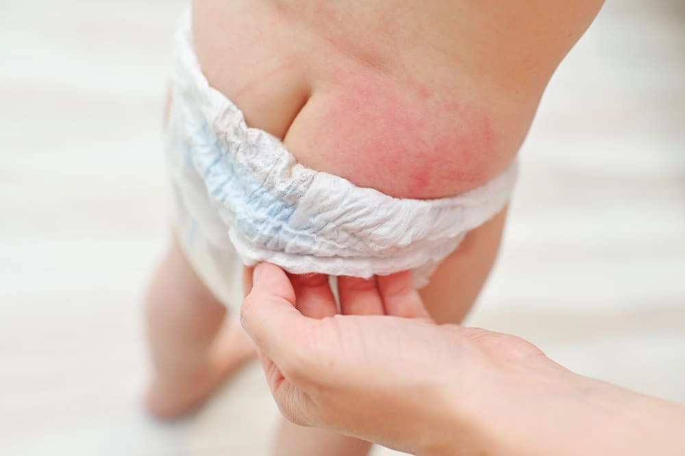 M&ugrave;a h&egrave; n&oacute;ng ẩm l&agrave; &ldquo;thủ phạm&rdquo; h&agrave;ng đầu khiến b&eacute; dễ bị hăm bỉm.