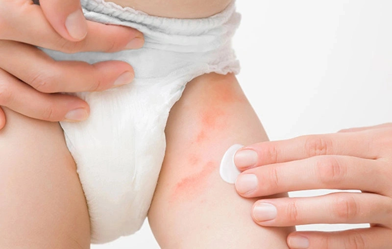 N&ecirc;n đưa b&eacute; đi kh&aacute;m nếu biểu hiện hăm t&atilde; trở n&ecirc;n trầm trọng v&agrave; k&eacute;o d&agrave;i.
