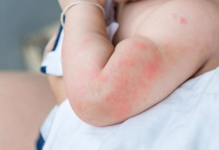 Trẻ dị ứng đạm sữa b&ograve; th&igrave; n&ecirc;n uống sữa g&igrave;?